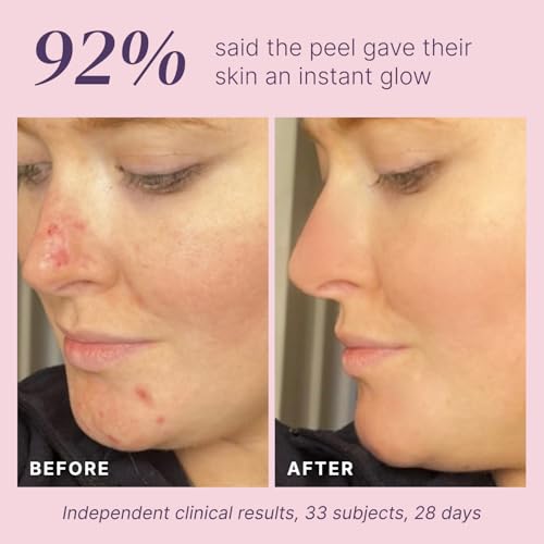 Glycolic Acid Peel 40% - Professional Chemical Face Exfoliant for Acne Scars & Wrinkles, 1 Fl Oz - Variation of THIS listing
