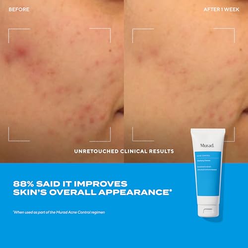 Murad Acne Treatment Trial Kit - 3 Pack Sample Set for Clear Skin
