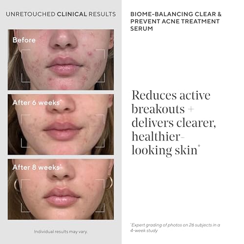 Murad Acne Treatment Trial Kit - 3 Pack Sample Set for Clear Skin
