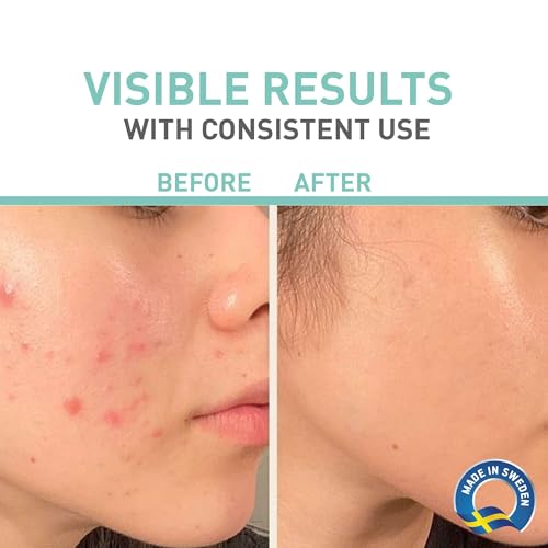 Acne Treatment Kit with Foaming Cleanser, Toner & Sebum Control Cream - 2 Month Supply