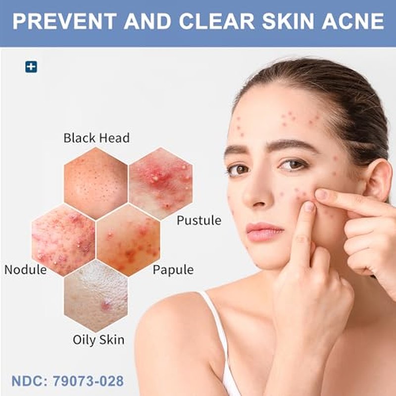 Acne Treatment Bar Soap for Face and Body, Medicated Soap Bar Treats Acne Pimples, Whiteheads, Blackheads, Acne Scars and Dark Spot Remover with Tea Tree Oil, Soap Bar for Acne, 4 oz, 1-Pack