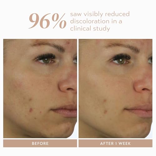 Shani Darden Azelaic Acid Serum - Brightening & Skin Tone Corrector, Vegan, 1 fl oz