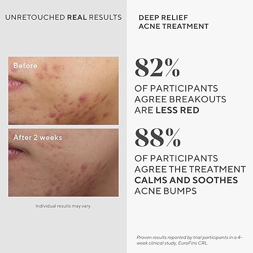 Murad Deep Relief Acne Treatment with 2% Salicylic Acid - Deep, Painful Acne Spot Treatment for Face ? Redness Relief, Fast Acting Blemish Serum, Soothing Breakout Treatment - 1Fl Oz