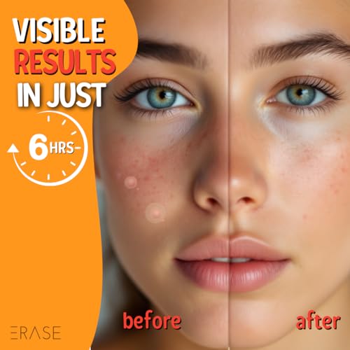 Erase Pimple Patches for Face - Fast-Acting Acne Patches with Hydrocolloid Patch Technology, 108 Patches: Parches Para Acne Invisible Design, Secure Adhesion for Proactive Acne Treatment for Face