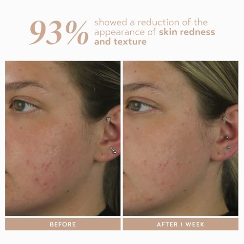 Shani Darden Azelaic Acid Serum - Brightening & Skin Tone Corrector, Vegan, 1 fl oz