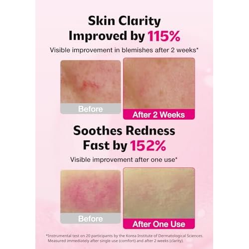 ISOI Blemish Care Up Serum for Face, Vegan Hydrating Serum for Smooth & Glass Skin Effect, Skin Barrier & Moisture Balance for Women, Arbutin & Rose Otto Oil, Korean Skin Care (2.36 fl. oz, 70ml)