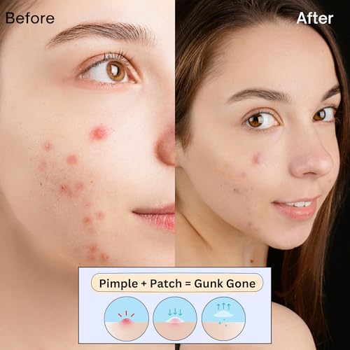 Sporty Acne Patches ? Hydrocolloid Spot Cover for Zits, Pimples & Blemishes, Fast-Acting Formula, Long-Lasting & Gentle on Skin. (36 Count)