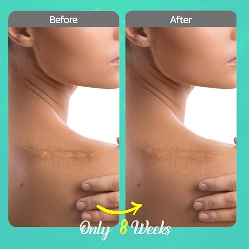 Scar Cream for Keloid Bump Removal: Professional Silicone Gel for Keloids, Acne Scars, Stretch Marks, C-Section & Burn Marks ? Old & New Scar Care Treatment, 1 oz