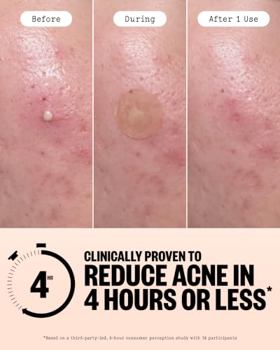 Acne Care Kit with Salicylic Acid Clear Skin Routine - 3 Pieces