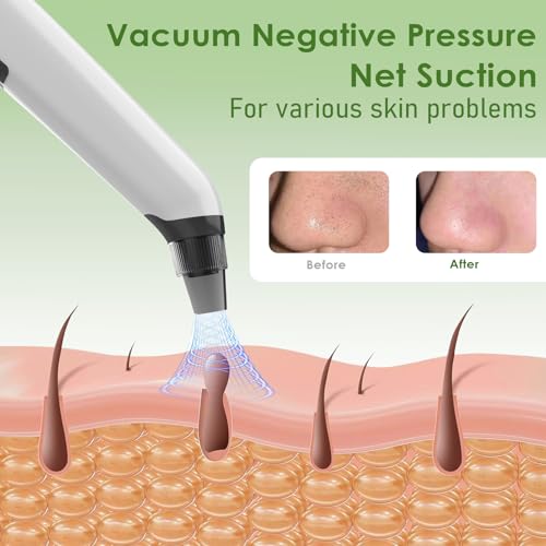 Blackhead Remover Pore Vacuum - Electric Facial Pore Cleaner with 3 Suction Levels & 3 Replaceable Probes - Professional Blackhead Extraction Tool Kit with 4 Stainless Steel Tools for Men & Women