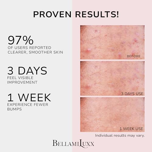Butt Acne Treatment Set: Acne Soap Bar + Butt Treatment Lotion for Breakouts on Buttocks, Thighs, Back, Chest & Ingrown-Prone & Folliculitis-Prone Skin ? Helps Reduce Body Breakouts