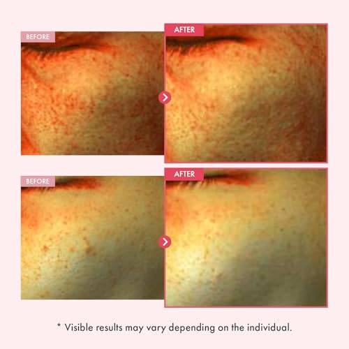 Niacinamide 10% + Arbutin 7% Dark Spot Serum for Hyperpigmentation & Uneven Tone