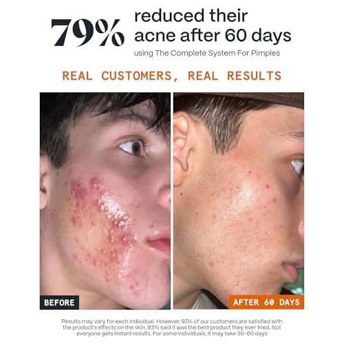 Norse Organics Pimple Stopper Night Balm | Acne Spot Treatment for Redness and Soothing Skin | Natural Bioactive Ingredients Help Treat Blemishes and Breakouts | Dermatologist Approved Skincare | 1 oz