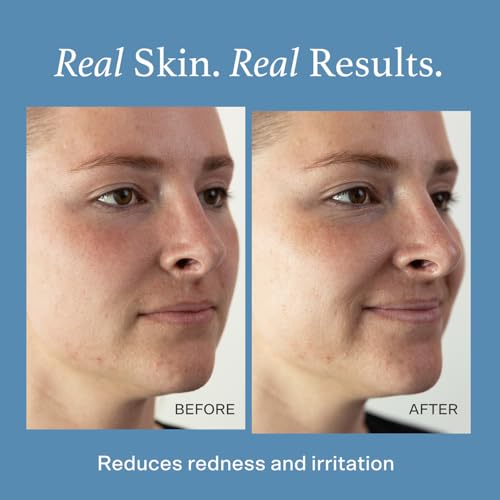 Hypochlorous Acid Face Mist for Sensitive Skin - 2.7 oz, Soothes Redness & Irritation