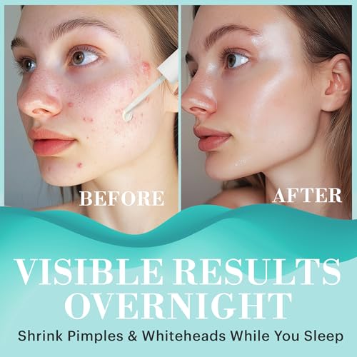 Targeted Acne Spot Treatment with Salicylic & Fruit Acids - Overnight Skin Solution (0.25 fl oz)