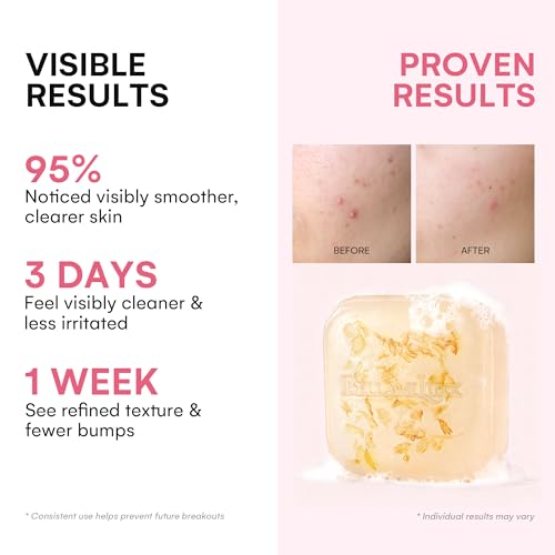Body Acne Soap Bar: Antibacterial Bar for Butt, Thighs, Back, Body Acne, Folliculitis & Fungal Prone Skin - Tea Tree Oil, Sulfur & Salicylic Acid Soap - Reduce Bumps, Clogged Pores