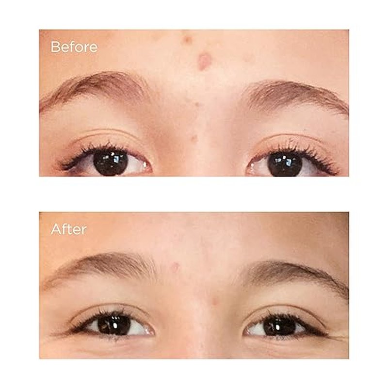 Acne Relief Prebiotic Acne Therapy
