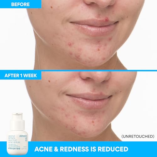 Gentle Retinol Serum with Salicylic Acid for Acne & Clear Skin - Korean Face Treatment