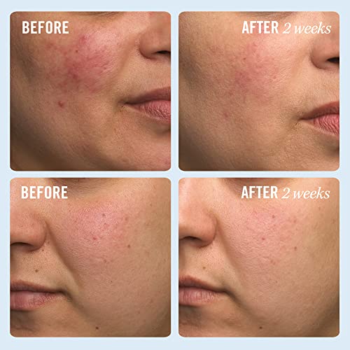 First Aid Beauty - Ultra Repair Cream - Intense Hydration Face & Body Moisturizer - Whipped Colloidal Oatmeal Clinically Proven to Strengthen Skin Barrier in 7 Days - Helps Relieve Eczema, 1 oz