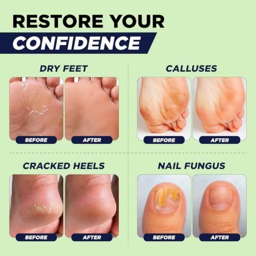 Tea Tree Oil Foot Soak with Epsom Salt for Foot Care & Nail Repair