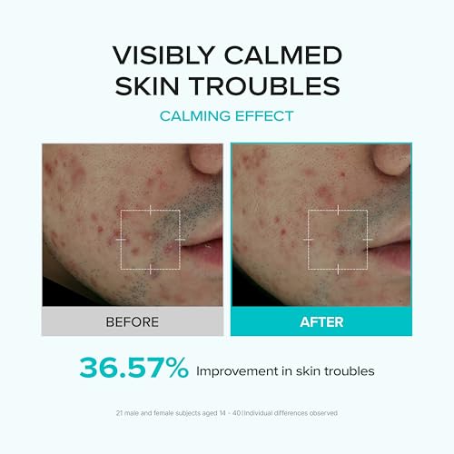 Azelaic Acid Serum 10% for Blemish-Prone Skin - Lightweight, Soothing & Pore Refining