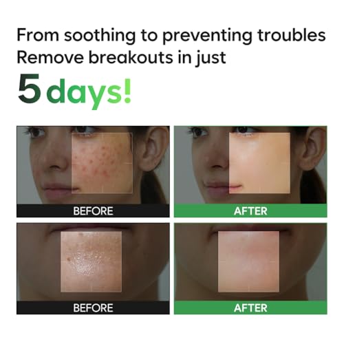 SAEKDONG Seoul Tea Tree Cica Bubble Serum for Acne-Prone Skin 1.01 fl oz