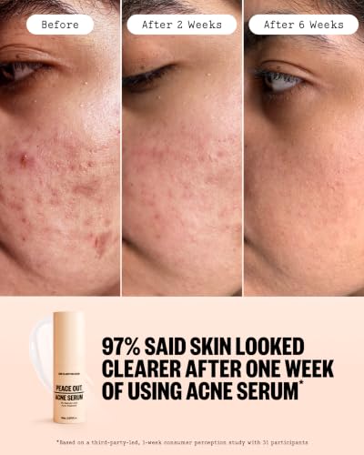 Acne Care Kit with Salicylic Acid Clear Skin Routine - 3 Pieces