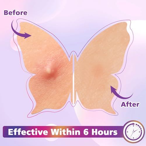 Acne Pimple Patches for Face (160 Counts), Hydrocolloid Acne Patches with Tea Tree Oil and Calendula Extract, Cute Colorful Butterfly Shape Spot Stickers for Skin Care, Zit Patches