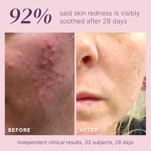 Glycolic Acid Peel 40% - Professional Chemical Face Exfoliant for Acne Scars & Wrinkles, 1 Fl Oz - Variation of THIS listing