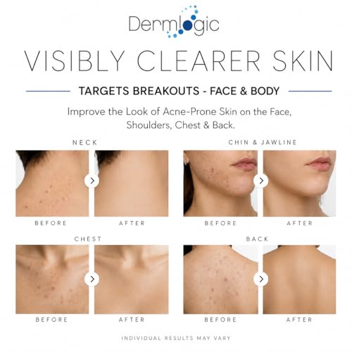 Dermlogic Acne Spot Treatment - Fast-Acting Clear Skin Formula for Face & Body