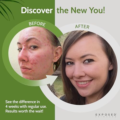 Acne Facial Cleanser with 0.5% Salicylic Acid for Clear, Smoother Skin