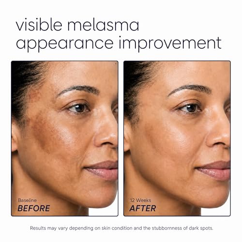 SINPIN Dark Spot Remover Serum for Face & Body - Hyperpigmentation Treatment