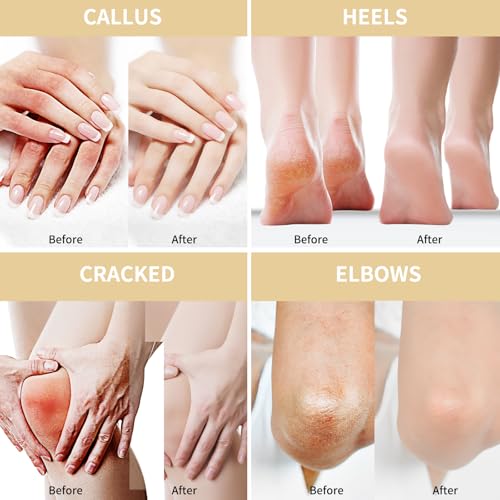 Grocerism Urea Cream 50 Percent for Feet 10.58 oz with Oat and 2% Salicylic Acid, Foot & Hand Cream included Hyaluronic Acid, Tea Tree and Aloe Vera for Deep Moisturizing, Callus Removing