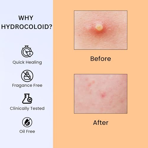 Sporty Acne Patches ? Hydrocolloid Spot Cover for Zits, Pimples & Blemishes, Fast-Acting Formula, Long-Lasting & Gentle on Skin. (36 Count)
