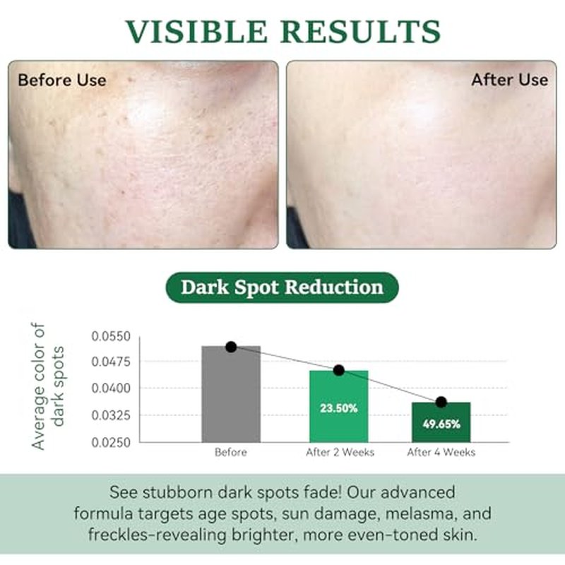 Dark Spot Remover for Face and Body - Dark Spot Corrector for Sun Spots Age Spots Freckles Melasma Brown Spot - Dark Spot Correcting Glow Serum with 360-Degree Roller 0.67 Fl Oz