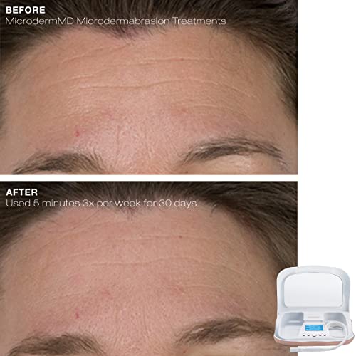 MicrodermMD Microdermabrasion Kit with Real Diamond Tips - White - Anti-Aging & Acne Treatment