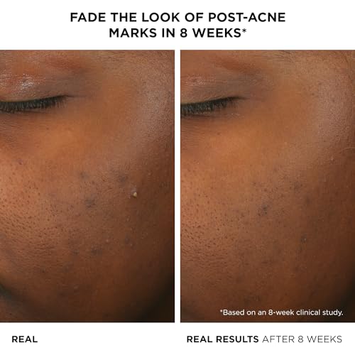Salicylic Acid Face Serum for Acne - Non-Drying & Calming, 2% Salicylic Acid