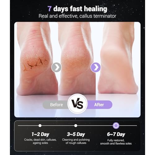 5-in-1 Professional Electric Callus Remover(Portable & Foldable), Removes 99.92% of Calluses in 3 Mins, Rechargeable Foot File Pedicure Kits with 10 & 40 Grit Pads for Soft Smooth Feet, Purple