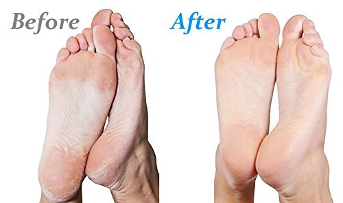Emjoi Micro-Pedi 3D POWER Callus Remover with Xtreme Coarse Soft & Flexible Roller (Most Powerful & Corded)