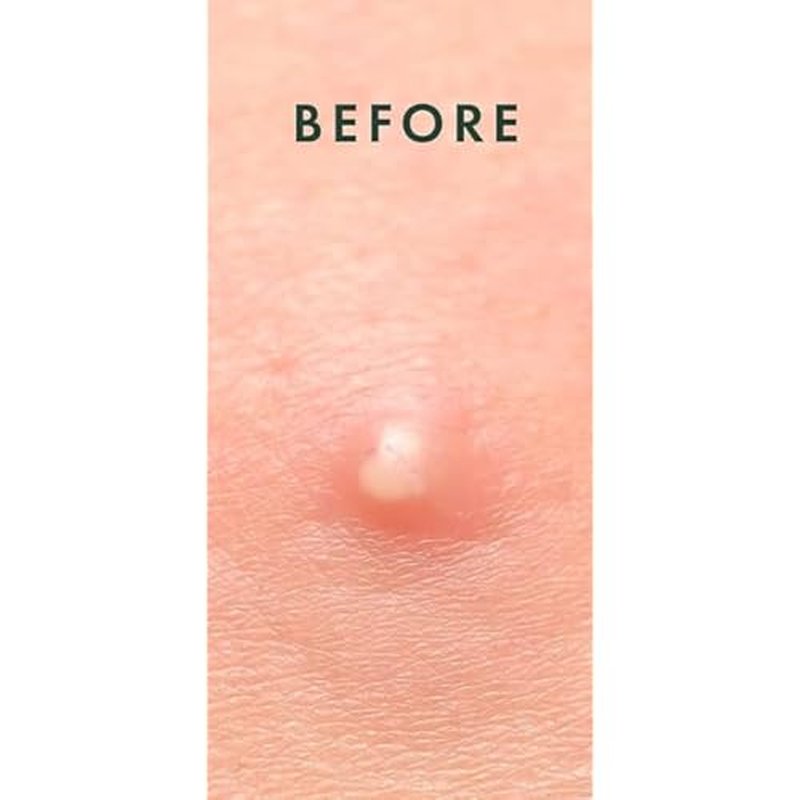 Kool Patch, The Overnight Emergency Pimple Patch, 72 Hydrocolloid Patches.