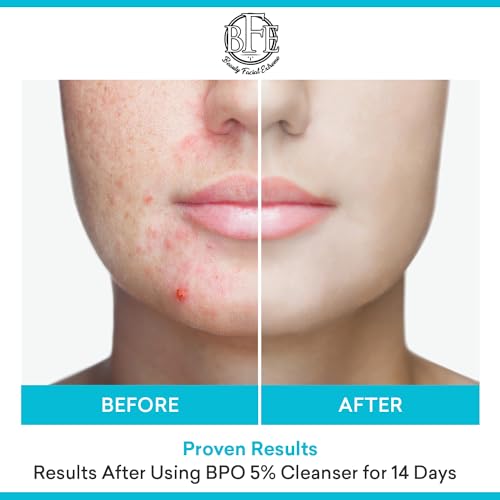 Acne Face Wash Treatment with 10% Benzoyl Peroxide for Oily Skin & Breakouts