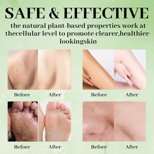 Tea Tree Soap Bar with Coconut & Witch Hazel – Deep Cleansing for Face & Body, Men & Women