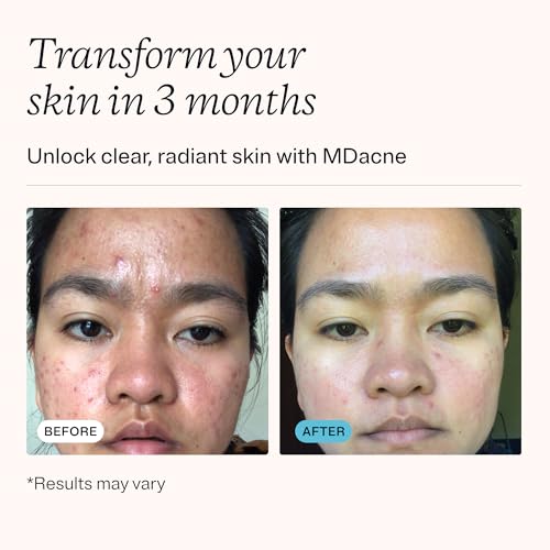 MDacne 2.5% Benzoyl Peroxide Acne Treatment Cream with Antioxidants & Hydrating Ingredients