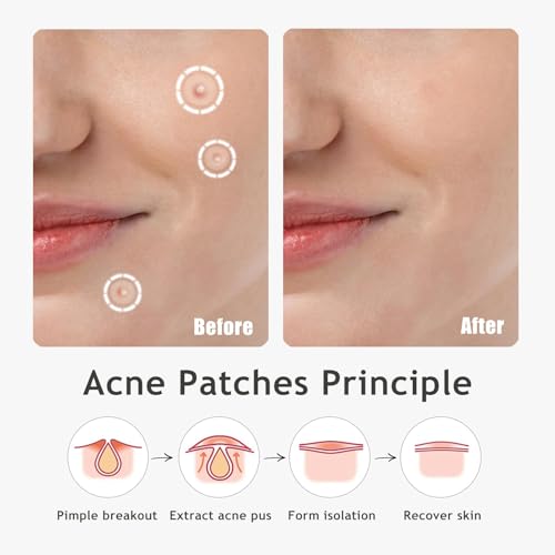 Ultra Pimple Patches - Hydrocolloid Acne Patch for Covering Zits and Blemishes Breakouts Spot Acne Dots Stickers for Face and Skin (120 count) 3 Size Day and Night Use