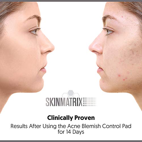 YISHIQIAnti-Blemish Acne Control Pads- Contains Salicylic, Lactic, & Mandelic Acid. Clears Away Clogged Pores, Whitehead & Blackhead Pimples. Eliminates Acne for Face & Body.