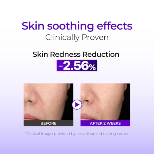 IZEZE Hyper CAA Cica Serum 1.01 Fl Oz, 30 ml | Centella Asiatica, Anti-fect, Soothing Serum for Face, Korean Skincare for Sensitive Skin, Acne Prone Skin