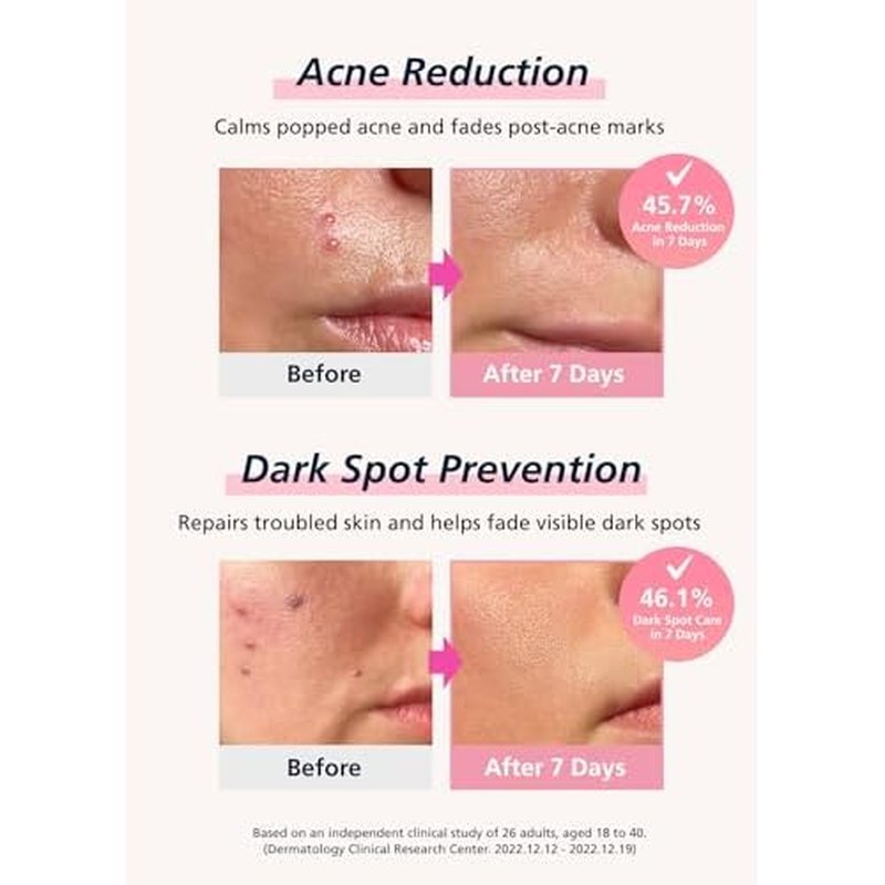 Easyderm Real Calming Patch Microdart Pimple Patches, Clear Nano Micropoint | Niacinamide, Hyaluronic Acid, EGF Acne Dark Spot Care, K-beauty | 12 Counts