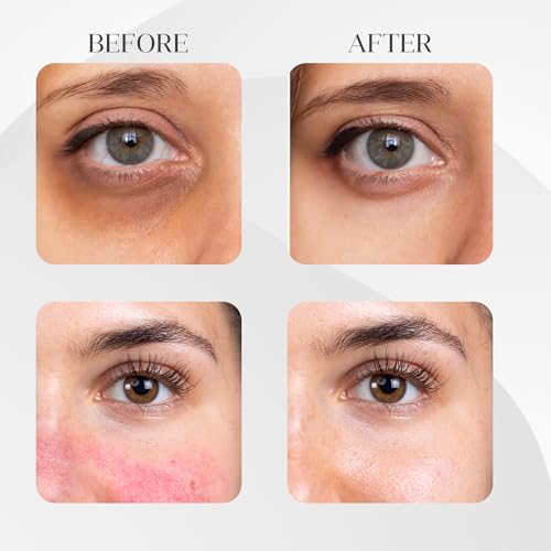FEEL MATRIGEN Vitamin K 100 Ampoule ? Redness & Dark Circle Treatment Serum for Sensitive Skin ? 30mL + Needleless Syringe