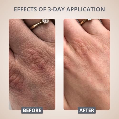 swederm Hudsalva Sensitive Eczema Hand Cream 1.69 Oz - Soothing and Moisturizing Hands and Foot Cream - Healing Ointment with Glycerine - Nourishes & Repair Dry Skin and Callus - Fast Absorbing