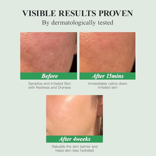 HKH Madagascar Centella Ampoule Serum - Soothing Acne Prone, Sensitive Skin Relief, Calming, Barrier Repair & Intense Hydration, 5X Centella Asiatica (Cica), 5X Ceramides, 8X Hyaluronic Acid, 30ml